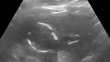 At Home Ultrasound